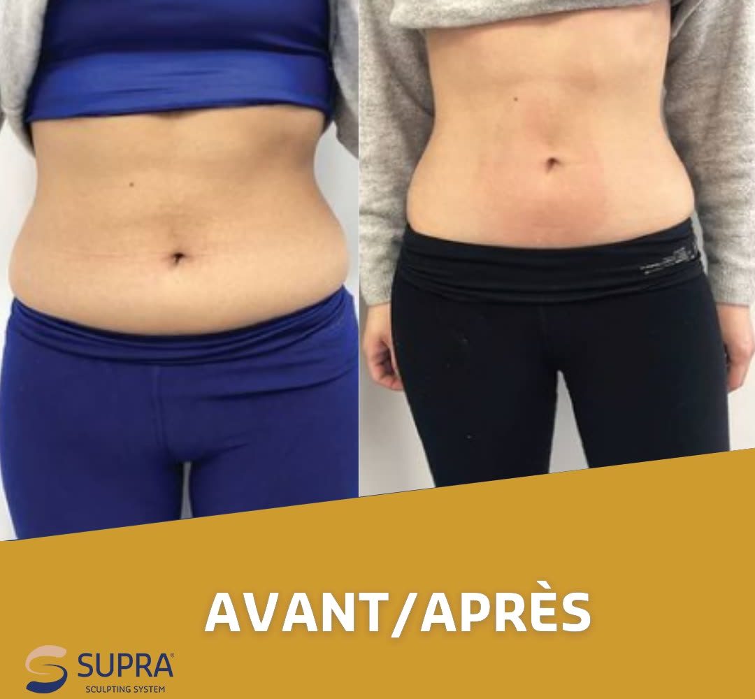Séance de Supra Sculpt au Studio Forme Réunion