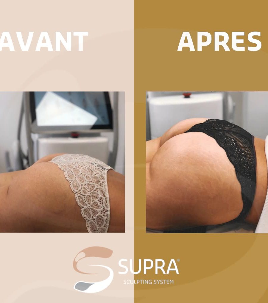Séance Supra Sculpt au Studio Forme Réunion